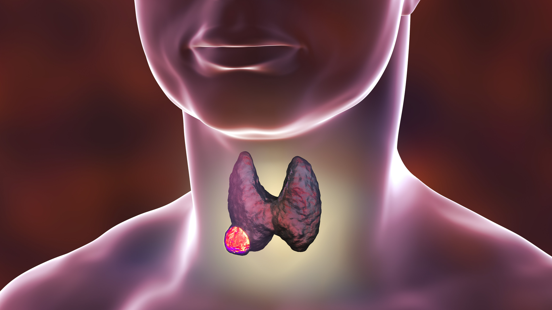 Sal yodada tiroides